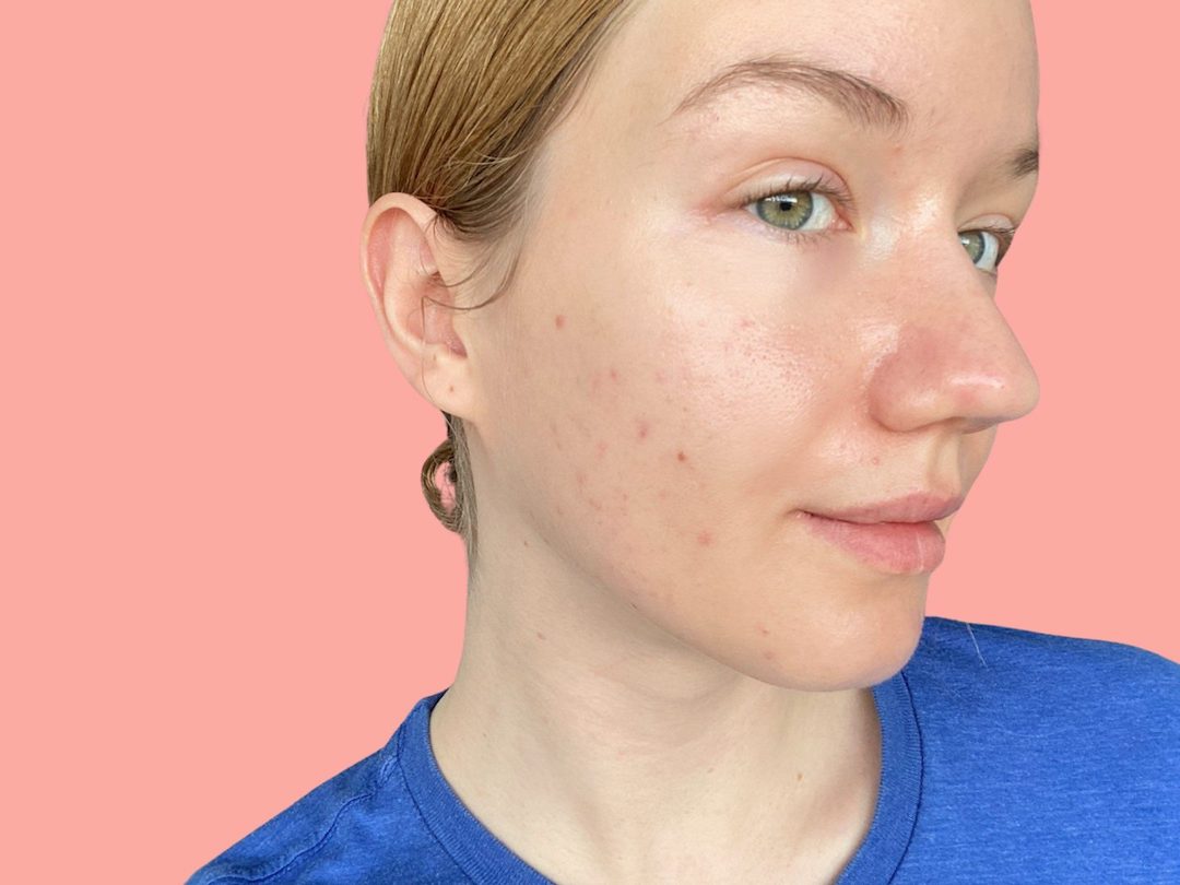 My Tretinoin Journey. How to protect your skin barrier and tretinoin skincare routine